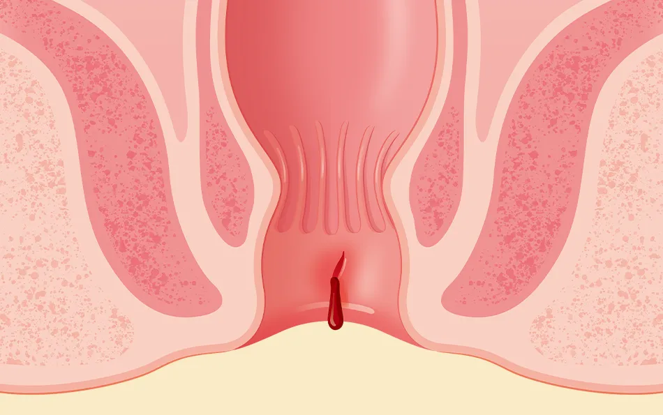 Anwendungsgebiet Analfissuren Schemendarstellung After mit Analfissur