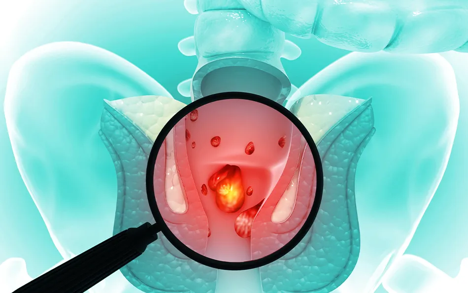 Anwendungsgebiet Hämorrhoiden Schemadarstellung des After mit Lupenvergrößerung auf blutige Stellen im Schließmuskelbereich