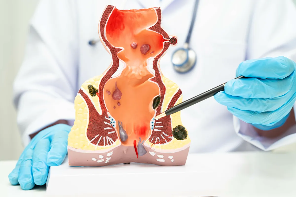 Anwendungsgebiete im Überblick Eine medizinische Fachkraft zeigt mit einem Kugelschreiber auf ein Model des Enddarm, explizit auf den After