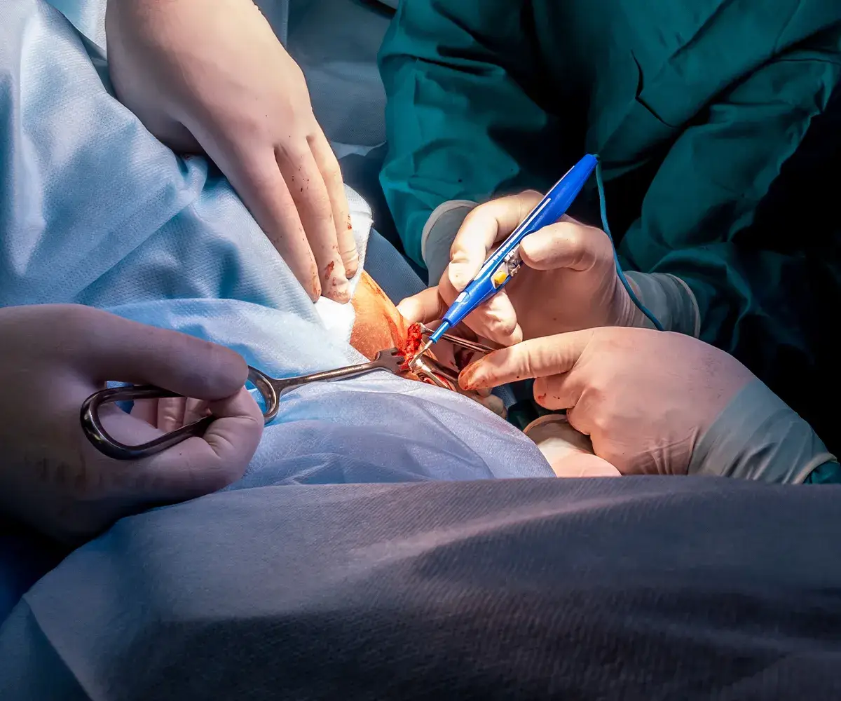 Entzündungen im Analbereich chirurgische Eingriffe Mehrere medizinische Klemmen und Halter von mehreren Händen gehalten vor einer blutigen Stelle gehalten.