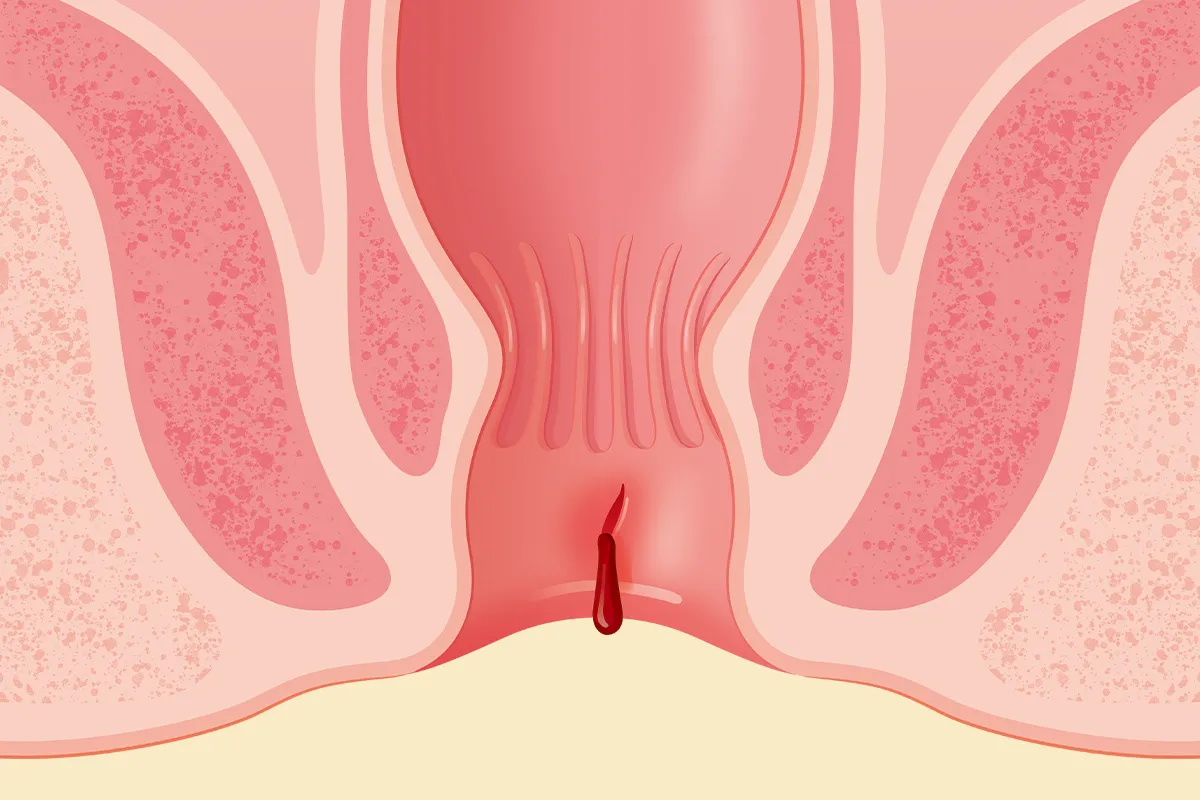 Entzündungen im Analbereich Überblick Schemendarstellung After mit Analfissur