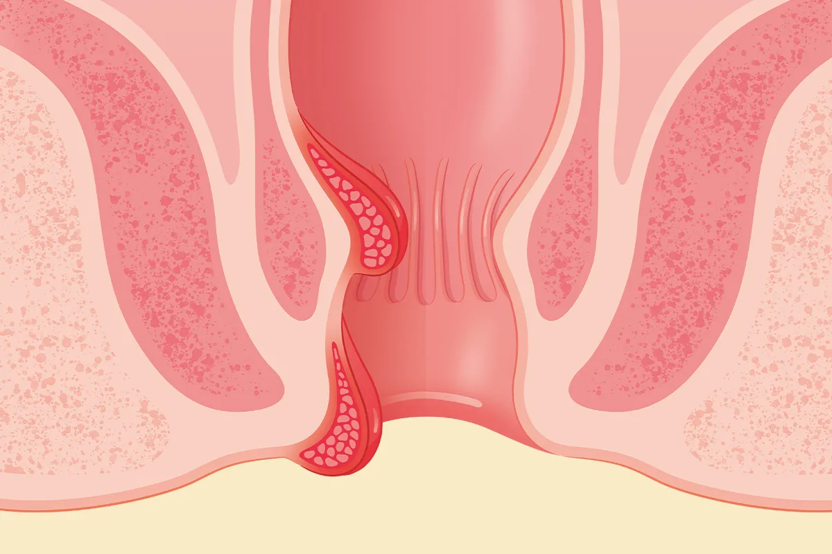Haemorrhoiden behandeln Linderung mit Lidoproct Schemendarstellung After mit Hämorrhoiden