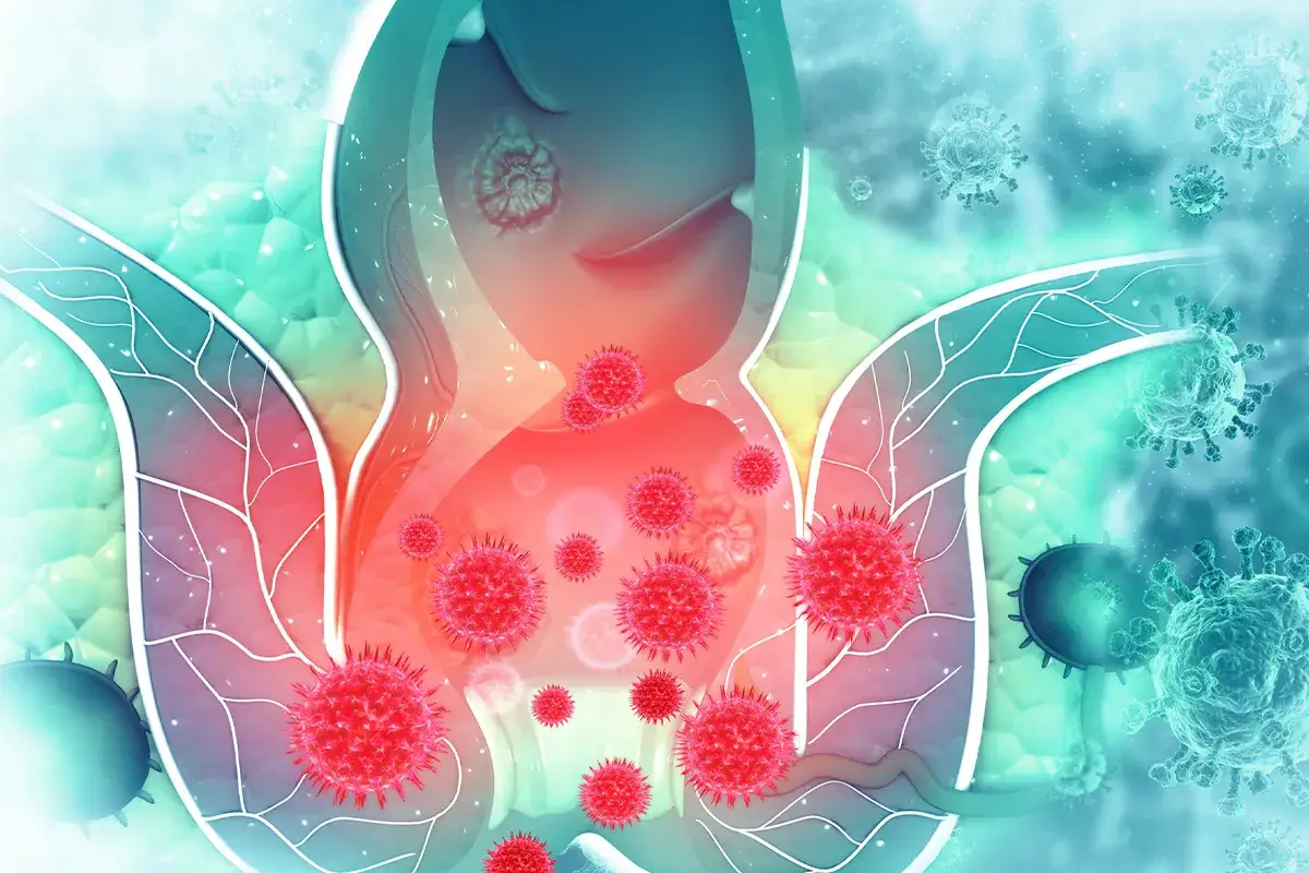 Lidoproct Rektalsalbe Wirkweise auf Hämorrhoiden Schemadarstellung Enddarm und After mit Viren davor