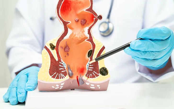 Lidoproct Salbe Anwendungsgebiete Eine medizinische Fachkraft zeigt mit einem Kugelschreiber auf ein Model des Enddarm, explizit auf den After