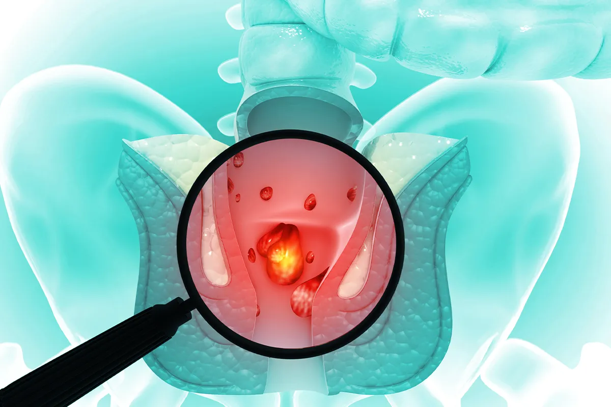 Schemadarstellung des After mit Lupenvergrößerung auf blutige Stellen im Schließmuskelbereich