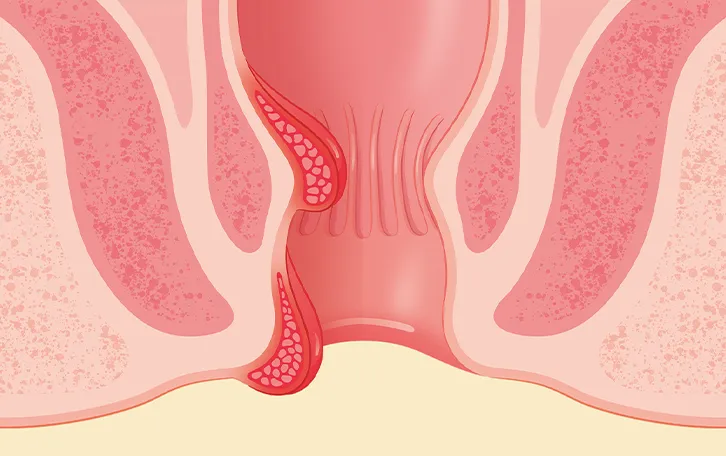 Schemendarstellung After mit Hämorrhoiden