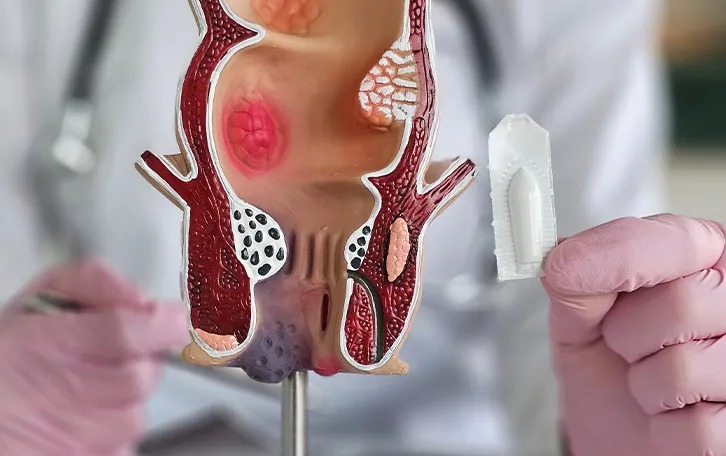 Modell des After mit Teil des Enddarm. Ein medizinisches Personal ist verschwommen im Hintergrund und hält ein Zäpfchen hoch