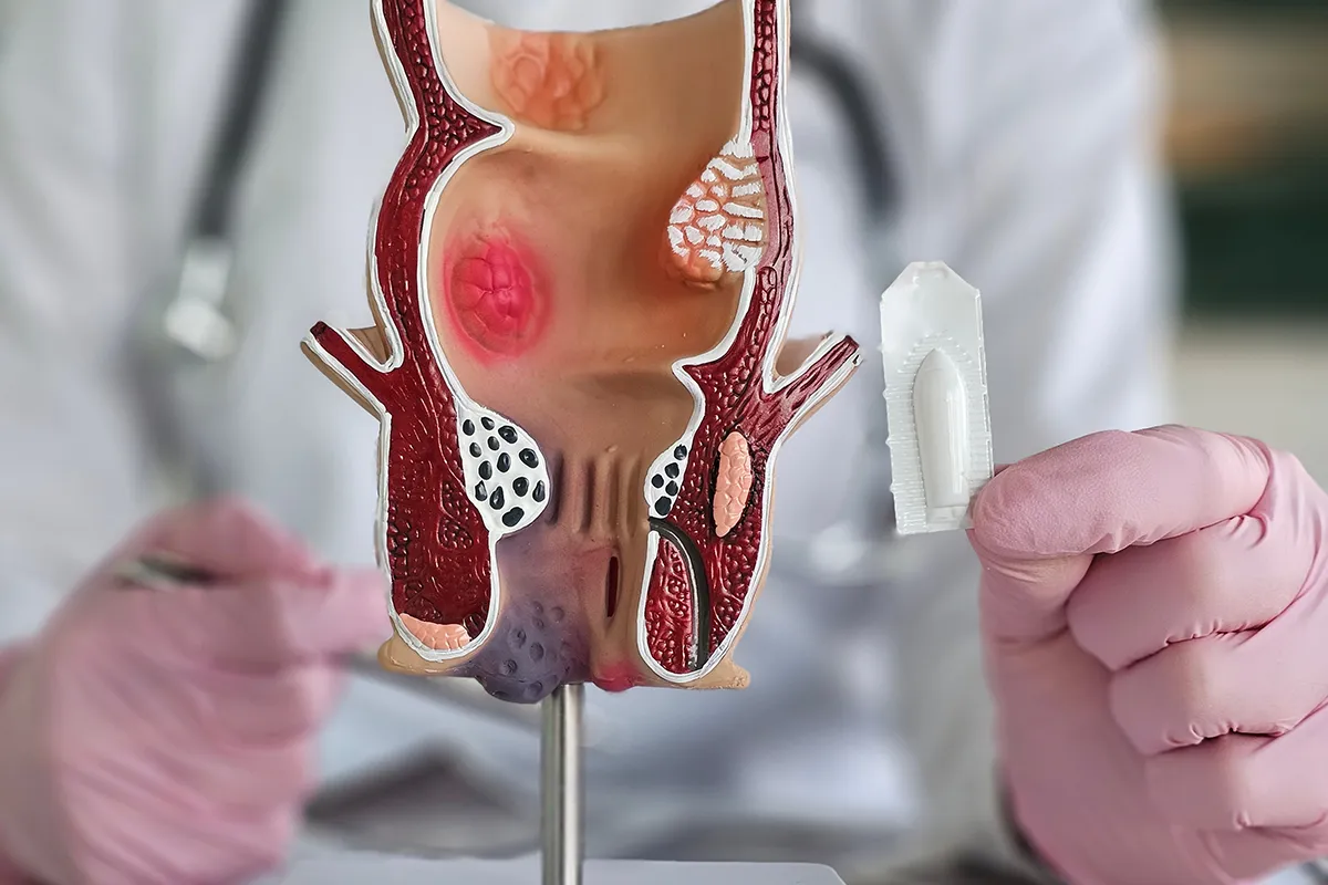 Rektalsalbe oder Zäpfchen Afterschmerzen Modell des After mit Teil des Enddarm. Ein medizinisches Personal ist verschwommen im Hintergrund und hält ein Zäpfchen hoch