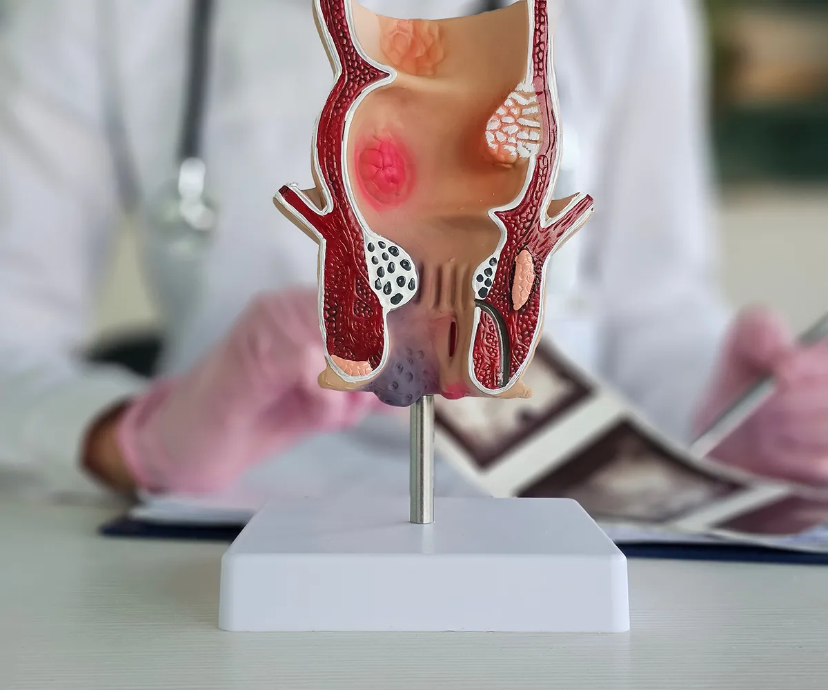 Salbe bei Afterjucken Anwendungshinweis Modell des After mit Teil des Enddarm. Ein medizinisches Personal ist verschwommen im Hintergrund und zeigt auf Bilder