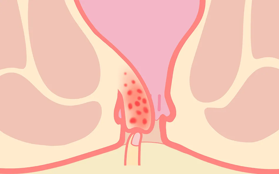 Verschiedene Stadien der Hämorrhoiden drei Stadium drei von Hämorrhoiden - Dauerhaft sichtbar und müssen manuell zurückgeschoben werden