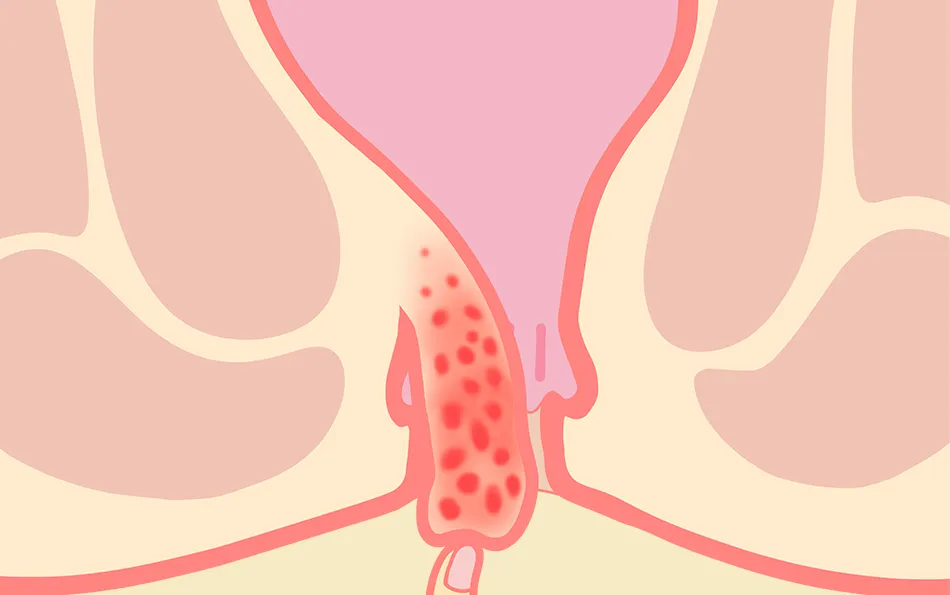 Verschiedene Stadien der Hämorrhoiden vier Stadium vier von Hämorrhoiden - Dauerhaft außerhalb des Körpers und können starke Schmerzen sowie Komplikationen verursachen