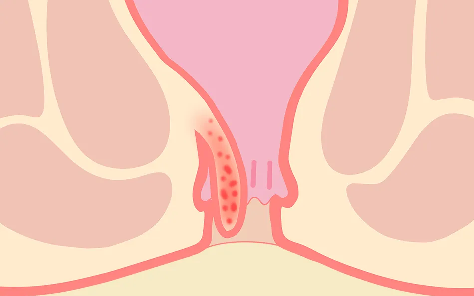 Verschiedene Stadien der Hämorrhoiden zwei Stadium zwei von Hämorrhoiden - Treten beim Stuhlgang hervor, ziehen sich aber wieder zurück